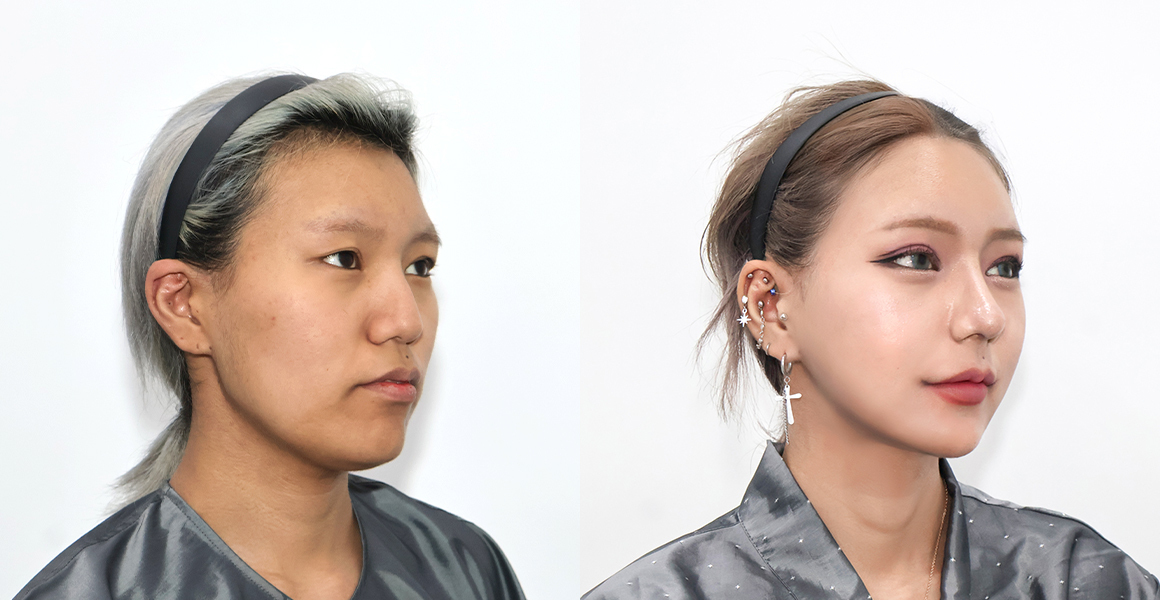 안면윤곽 전후사진 수술후기