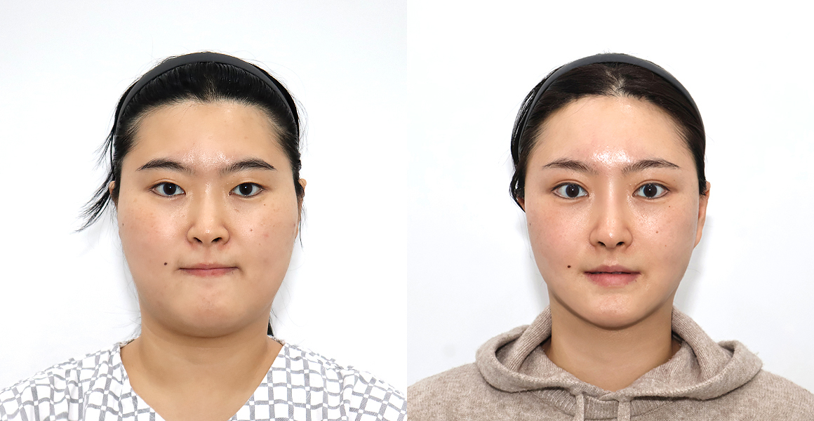 안면윤곽 전후사진 수술후기