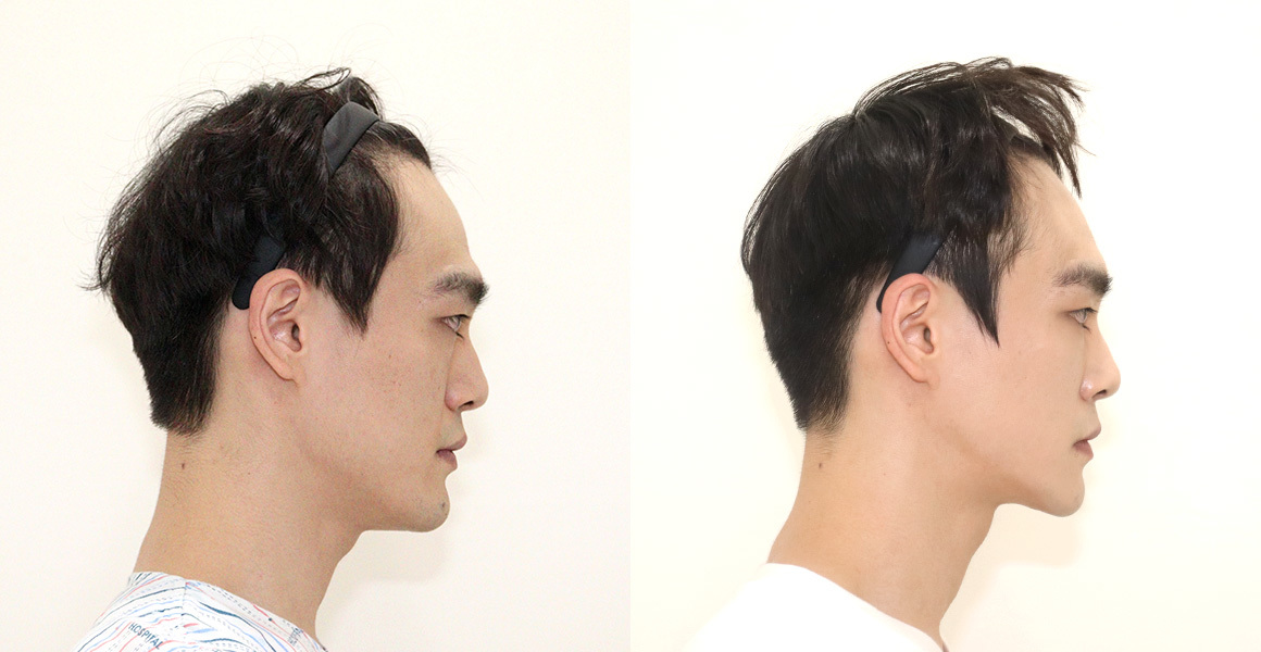 안면윤곽 전후사진 수술후기