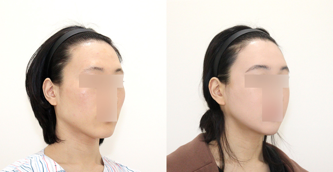 안면윤곽 전후사진 수술후기