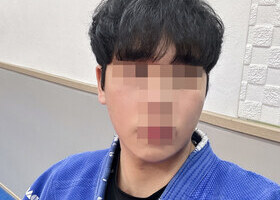 일퍼센트 윤곽 삼종 한달 후기입니다(하이3D광대축소술+