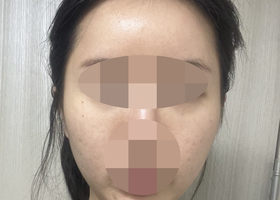 광대, 사각턱수술한지 1개월~