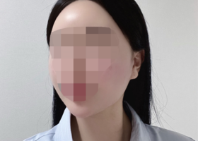 하이3D광대축소술 한지 오개월차입니당