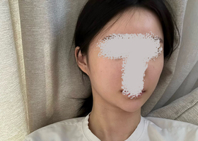 광대, 사각턱/ 윤곽 2종 후