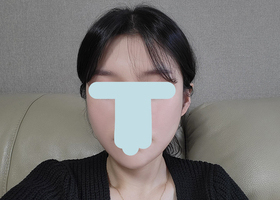 역시 안면윤곽은 임종우원장님이십니다!!
