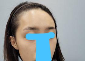 광대, 사각턱, 턱끝 벌써 5개월 후기~
