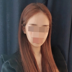 비스포크v라인+퀵광대, 1년 후 광대축소수술